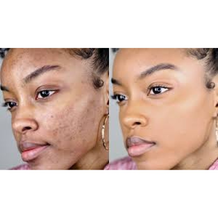Discover six(6) highly effective steps to get rid of Acne